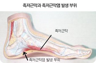 족저근막염